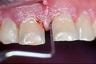 Gingivitis - Parodontologie Braunschweig Deutlich sichtbares Zahnfleischbluten
