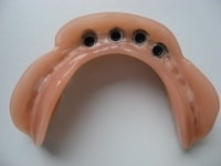 Prothese - Implantologie Braunschweig Prothese mit Implantathalterung